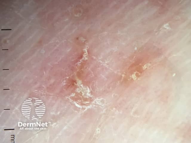 Dermoscopy of scabies burrow