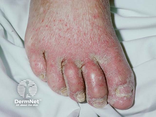 Scabies, foot