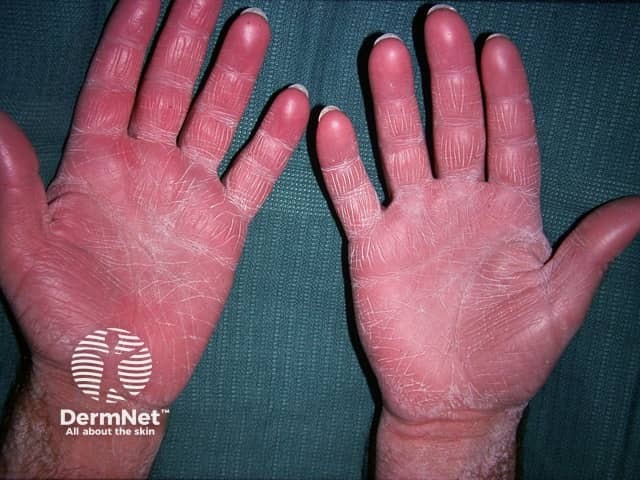 Acquired ichthyosis