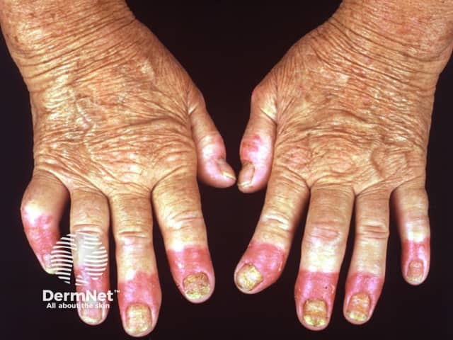 Acrodermatitis continua of Hallopeau