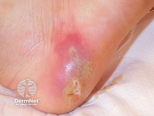 Cellulitis