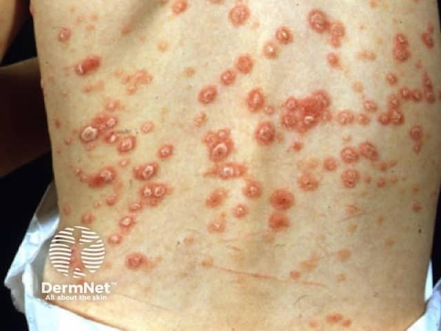 Guttate psoriasis in child