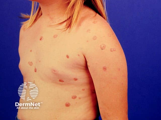 Psoriasis in child