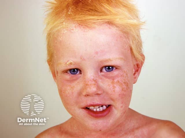 Facial psoriasis in child