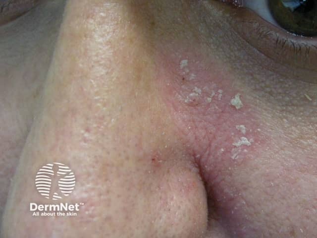 Facial psoriasis