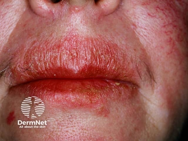 Facial psoriasis