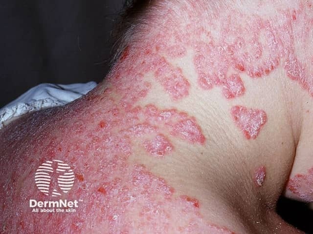 Facial psoriasis