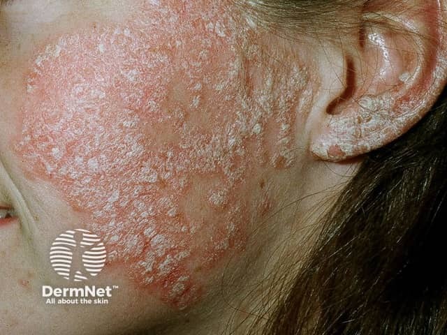 Facial psoriasis