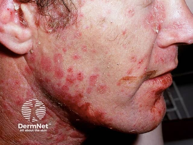 Facial psoriasis