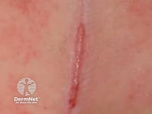 Flexural psoriasis