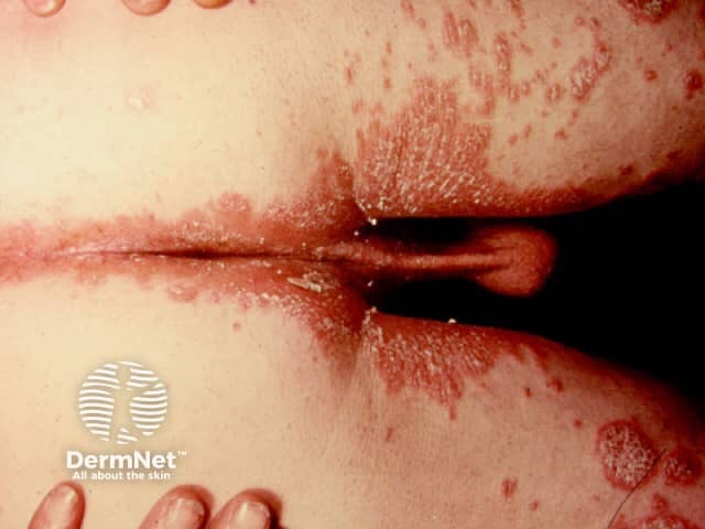 Genital psoriasis