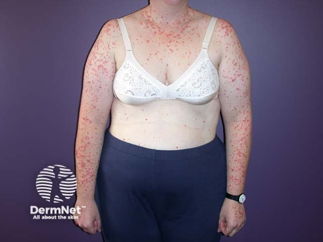 Guttate psoriasis