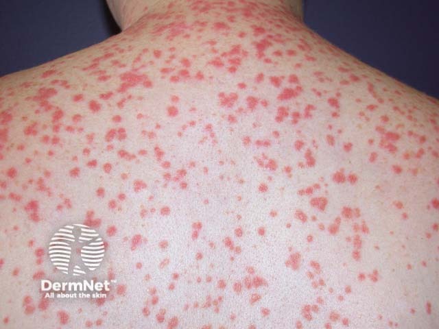 Guttate psoriasis