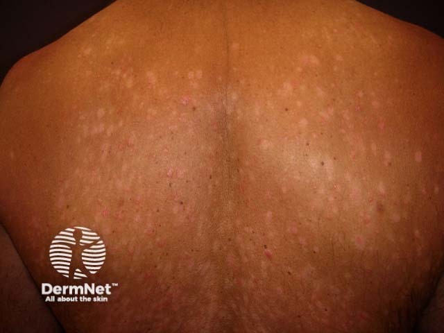 Guttate psoriasis