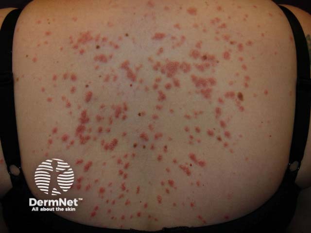 Guttate psoriasis