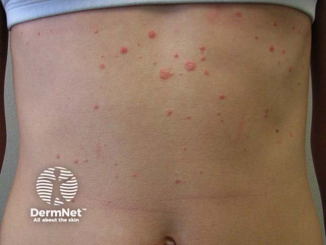 Guttate psoriasis