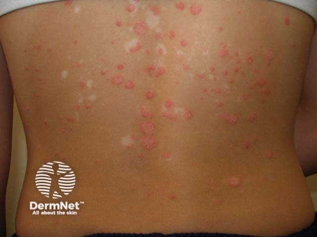 Guttate psoriasis