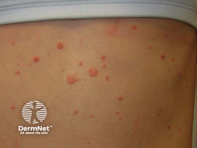 Guttate psoriasis