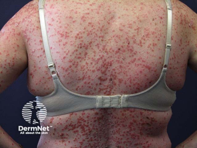 Guttate psoriasis