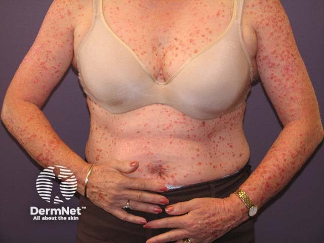 Guttate psoriasis