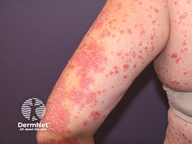 Psoriasifom eruption induced by pembrolizumab