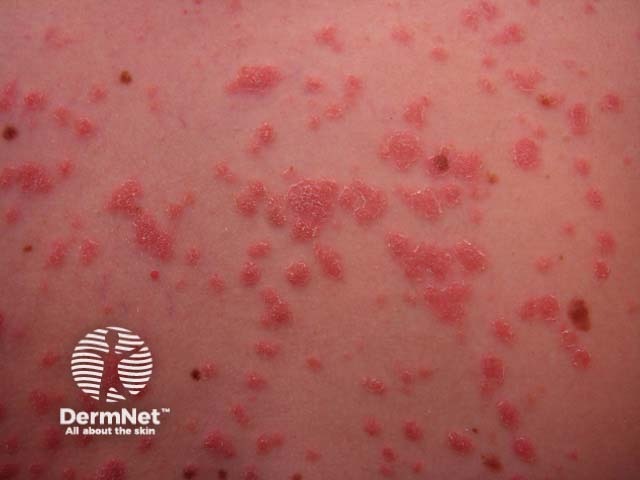 Close up of guttate psoriasis