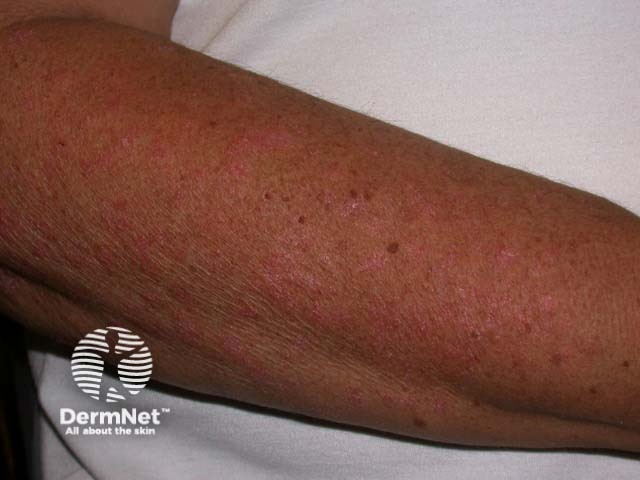 Guttate psoriasis