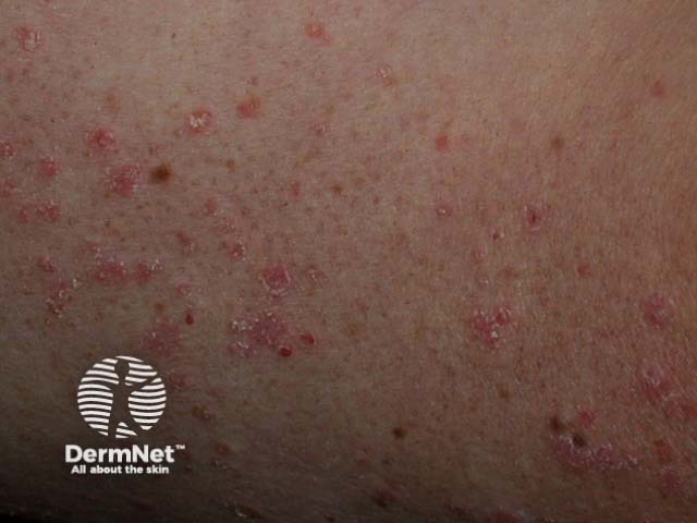 Guttate psoriasis