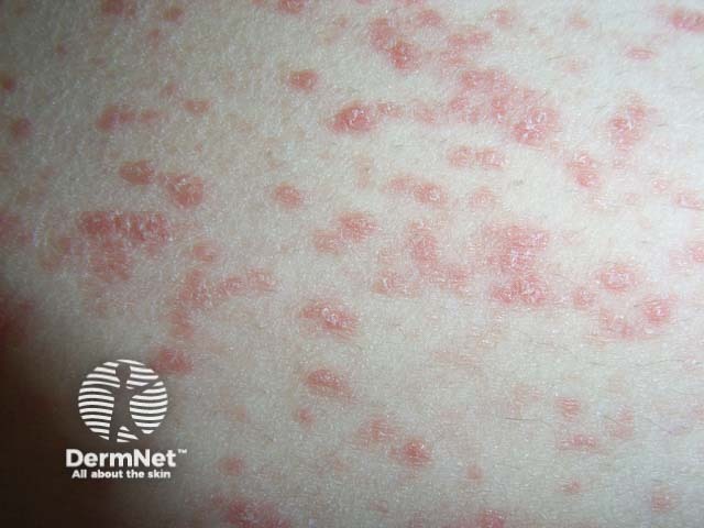 Guttate psoriasis