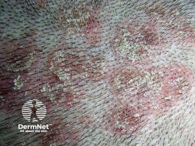 Guttate psoriasis