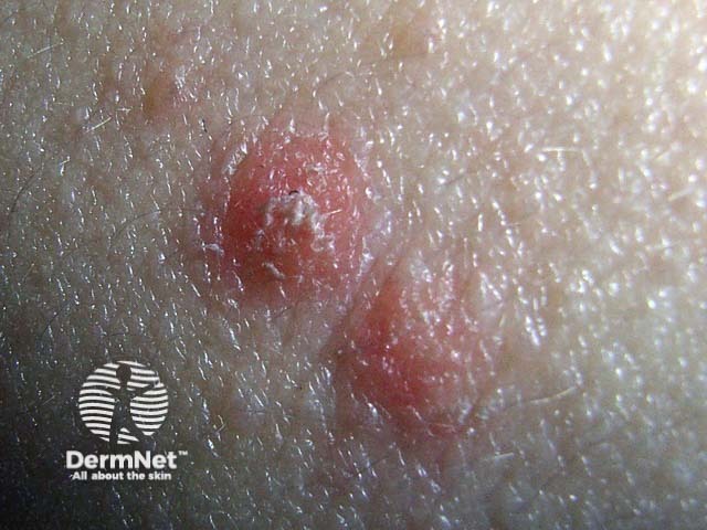 Guttate psoriasis