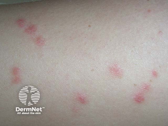 Guttate psoriasis