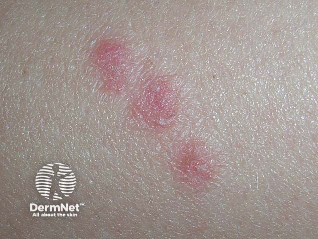 Guttate psoriasis