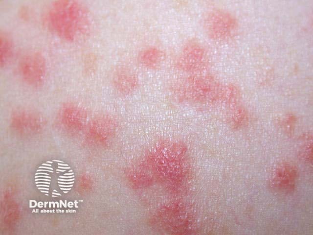 Guttate psoriasis