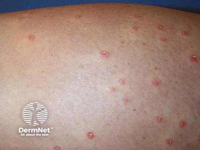 Guttate psoriasis