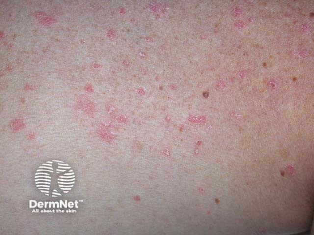 Guttate psoriasis