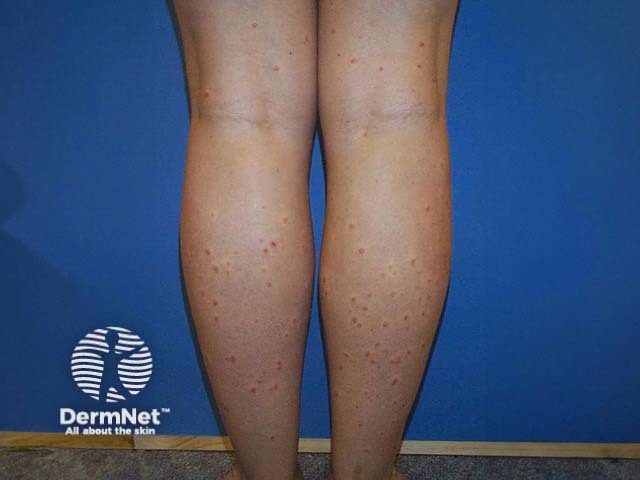 Guttate psoriasis