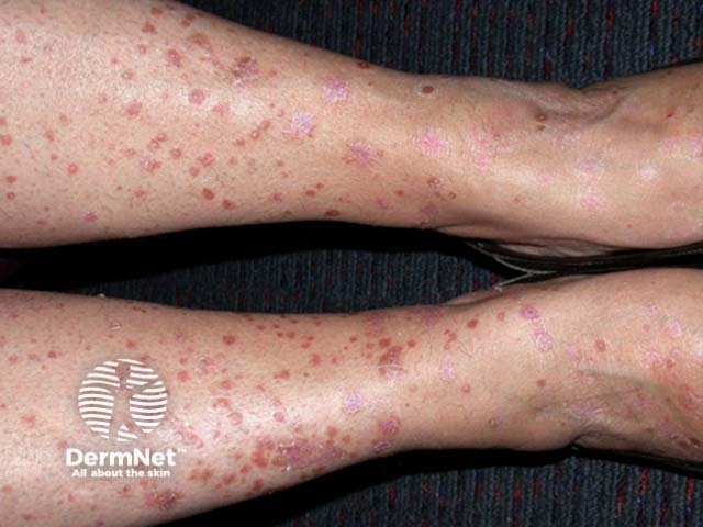 Guttate psoriasis