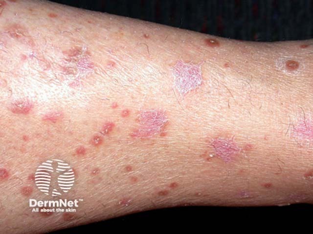 Guttate psoriasis