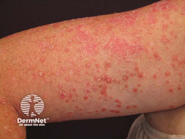 Guttate psoriasis