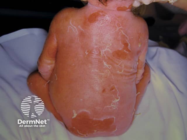 Epidermolytic ichthyosis