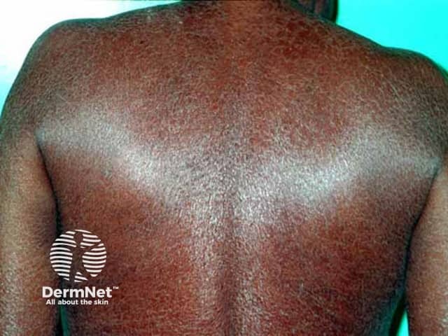 Kava ichthyosis