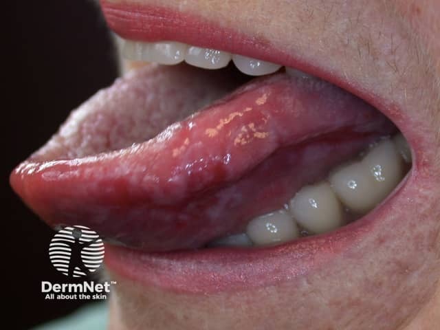 Erosive oral lichen planus