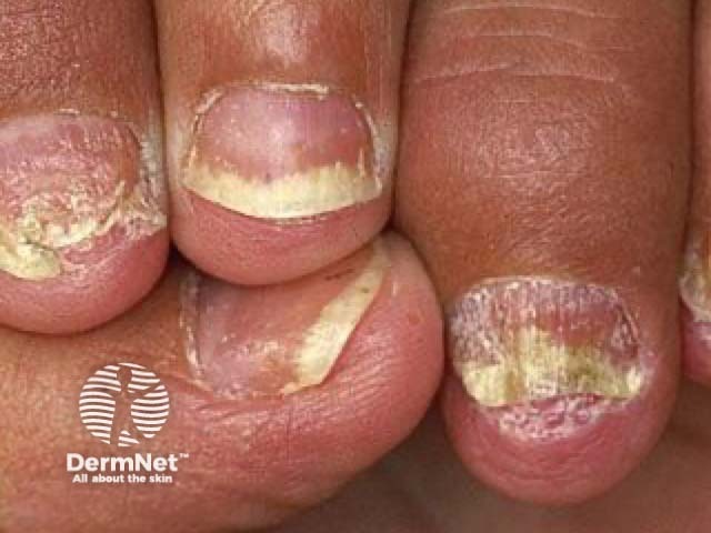 Nail psoriasis