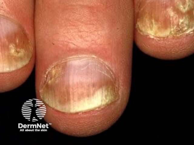 Nail psoriasis