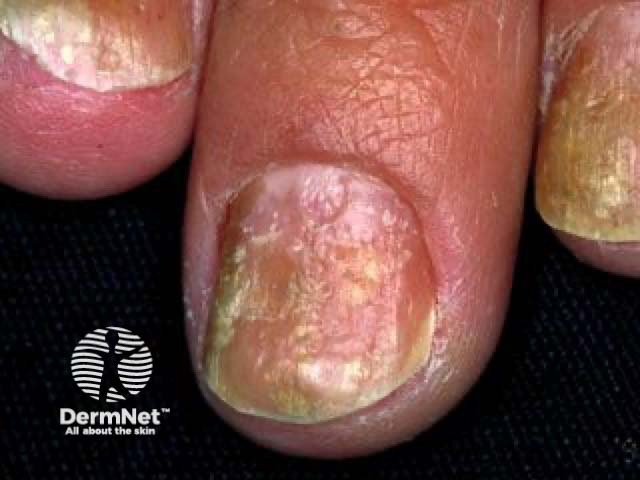 Nail psoriasis