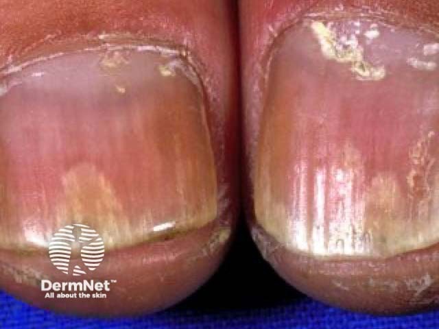 Nail psoriasis