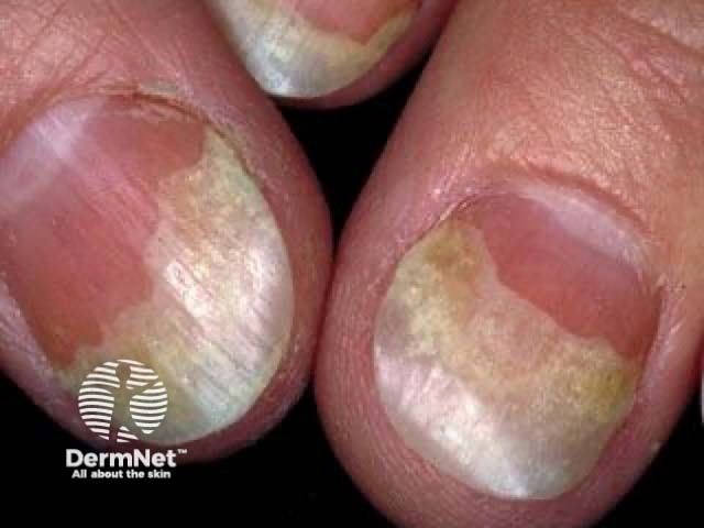 Nail psoriasis