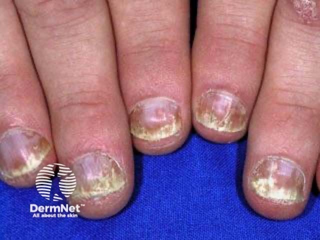 Nail psoriasis