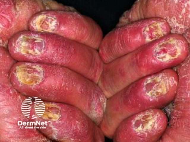 Nail psoriasis